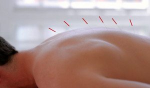 Acupunctura en espalda