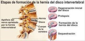 Hernia de disco