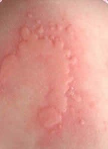 Alergias a las picaduras de mosquito