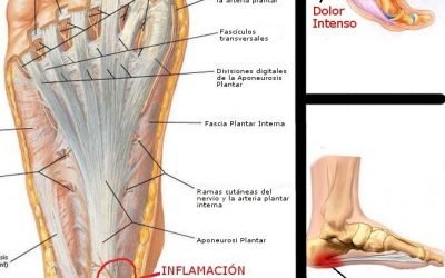 FASCITIS PLANTAR