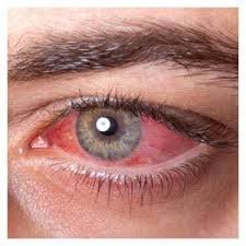 Conjuntivitis u ojo rojo