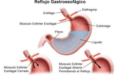 RECOMENDACIONES NUTRICIONALES PARA GASTRITIS