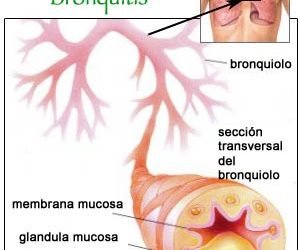BRONQUITIS Y BRONQUIOLITIS AGUDA