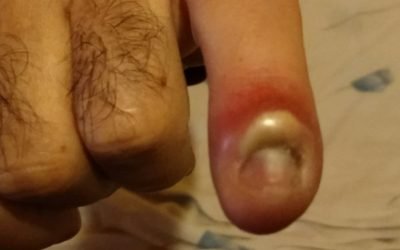 PANADIZO O PARONIQUIA